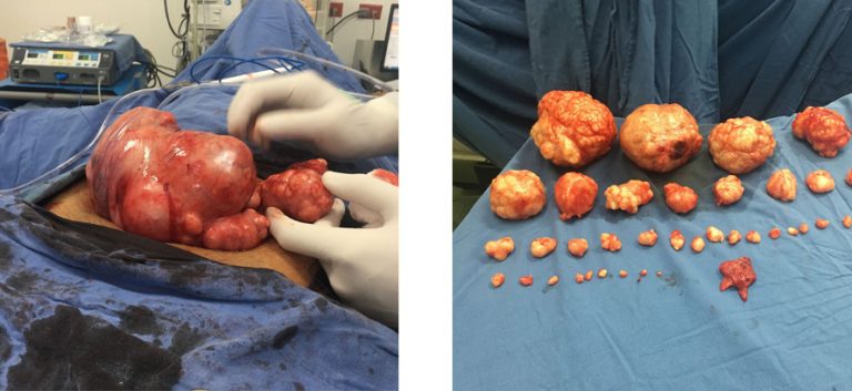 Miomectomia Medimujer